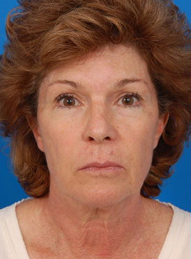 Woman's face, before Facelift treatment, front view, patient 2