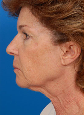 Woman's face, before Facelift treatment, l-side view, patient 2