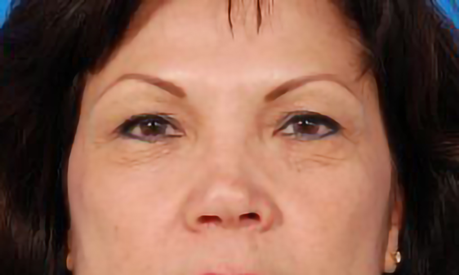 Female face, before Eyelid Surgery, front view, patient 9