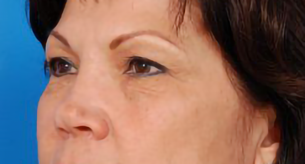 Female face, before Eyelid Surgery, l-side oblique view, patient 9