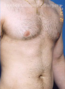 Male body, after Liposuction For Men treatment, r-side oblique view, patient 2
