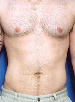 Male body, after Liposuction For Men treatment, front view, patient 2