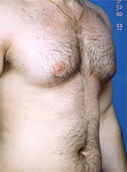 Male body, before Liposuction For Men treatment, r-side oblique view, patient 2
