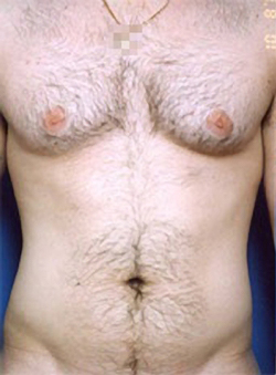 Male body, before Liposuction For Men treatment, front view, patient 2