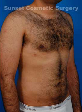 Male body, after Gynecomastia: Male Breast Reduction treatment, r-side oblique view, patient 3