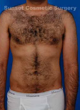 Male body, after Liposuction For Men treatment, front view, patient 3