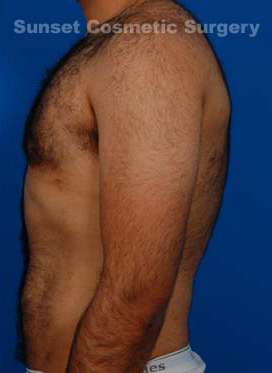 Male body, after Gynecomastia: Male Breast Reduction treatment, l-side view, patient 3