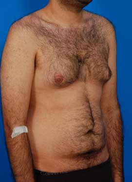 Male body, before Gynecomastia: Male Breast Reduction treatment, r-side oblique view, patient 3