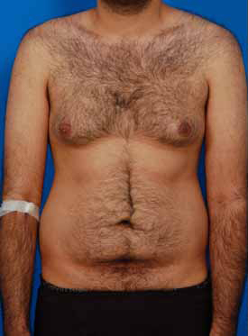 Male body, before Liposuction For Men treatment, front view, patient 3