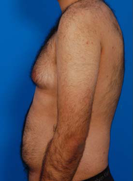 Male body, before Gynecomastia: Male Breast Reduction treatment, l-side view, patient 3