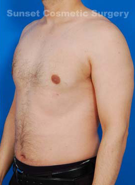 Male body, after Liposuction For Men treatment, l-side oblique view, patient 4