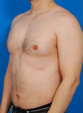 Male body, before Liposuction For Men treatment, l-side oblique view, patient 4