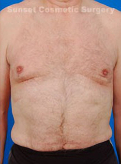 Male body, after Gynecomastia: Male Breast Reduction treatment, front view, patient 5