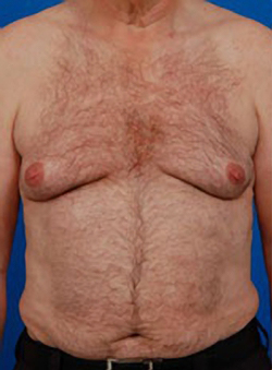 Male body, before Gynecomastia: Male Breast Reduction treatment, front view, patient 5