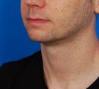 Male face - after Kybella Injection treatment, l-side oblique view, patient 1