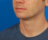 Male face, after Kybella Injection treatment, l-side oblique view, patient 1