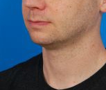 Male face, before Kybella Injection treatment, l-side oblique view, patient 1