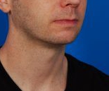 Male face - after Kybella Injection treatment, r-side oblique view, patient 1