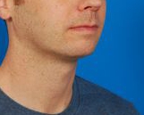 Male face, after Kybella Injection treatment, r-side oblique view, patient 1