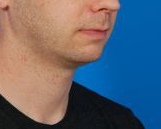 Male face, before Kybella Injection treatment, r-side oblique view, patient 1