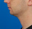 Male face - after Kybella Injection treatment, l-side view, patient 1