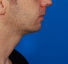 Male face - after Kybella Injection treatment, r-side view, patient 1