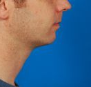 Male face, after Kybella Injection treatment, r-side view, patient 1