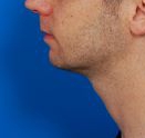 Male face, after Kybella Injection treatment, l-side view, patient 1