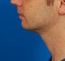 Male face, before Kybella Injection treatment, l-side view, patient 1