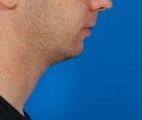 Male face, before Kybella Injection treatment, r-side view, patient 1