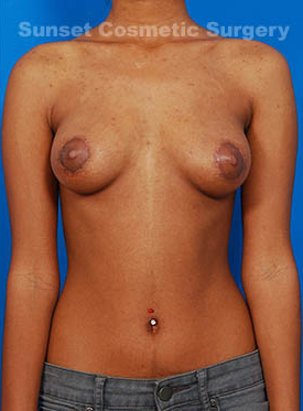 Female body, after Tuberous Breast Correction treatment, front view, patient 2