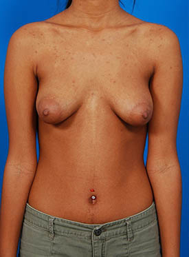 Female body, before Tuberous Breast Correction treatment, front view, patient 2