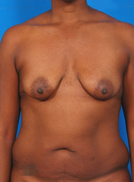 Breast Surgery, Uneven Breasts, Los Angeles