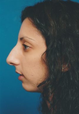 Female face, before Chin Implant treatment, l-side view, patient 4