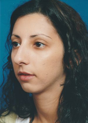Female face, before Chin Implant treatment, l-side oblique view, patient 4