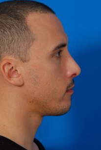 Male face, after Chin Implant treatment, r-side view of head, patient 94