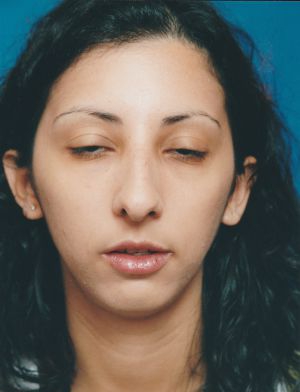 Female face, before Chin Implant treatment, front view, patient 4