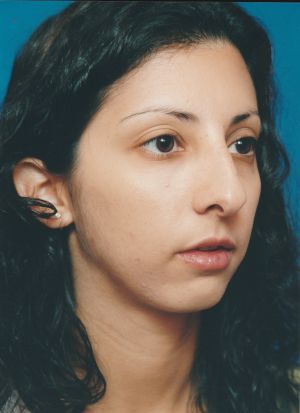 Female face, before Chin Implant treatment, r-side oblique view, patient 4