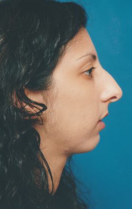 Female face, before Chin Implant treatment, r-side view, patient 4