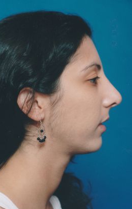 Female face, after Chin Implant treatment, r-side view, patient 4