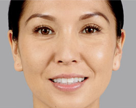 Female face, after juvederm-voluma treatment, front view, patient 1