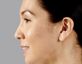 Female face, after juvederm-voluma treatment, l-side view, patient 1