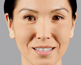 Female face, before juvederm-voluma treatment, front view, patient 1