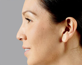 Female face, before juvederm-voluma treatment, l-side view, patient 1