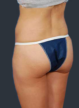 Woman's body, after Brazilian Butt Lift treatment, r-side back view, patient 1