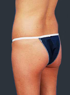 Woman's body, before Brazilian Butt Lift treatment, r-side back view, patient 1