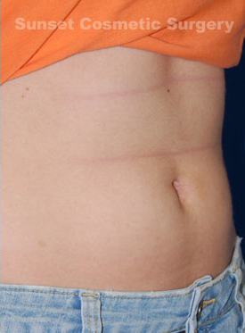 Woman's tummy, after Belly Button Surgery treatment, r-side oblique view, patient 1