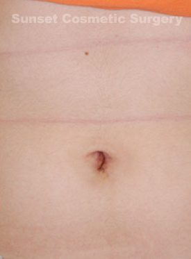 Woman's tummy, after Belly Button Surgery treatment, front view, patient 1