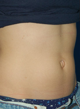 Woman's tummy, before Belly Button Surgery treatment, r-side oblique view, patient 1