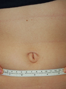 Woman's tummy, before Belly Button Surgery treatment, front view, patient 1